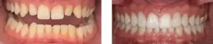 before and after of patients teeth crocked to straight 